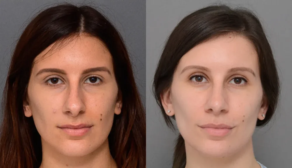 Primary Rhinoplasty case #40380