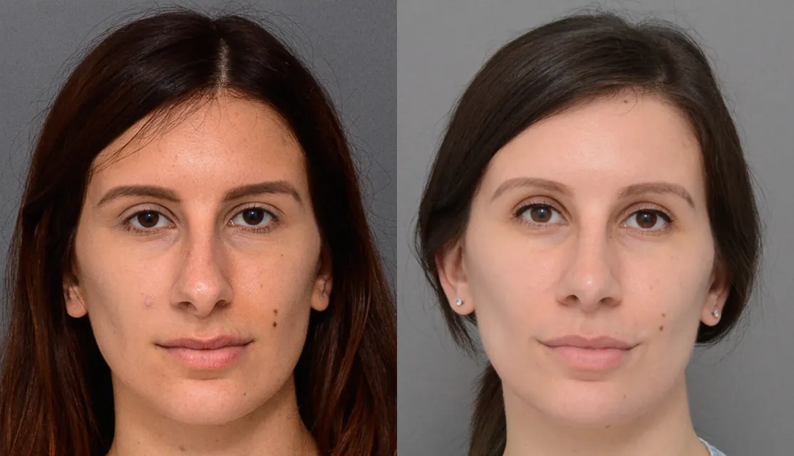 Primary Rhinoplasty case #40380