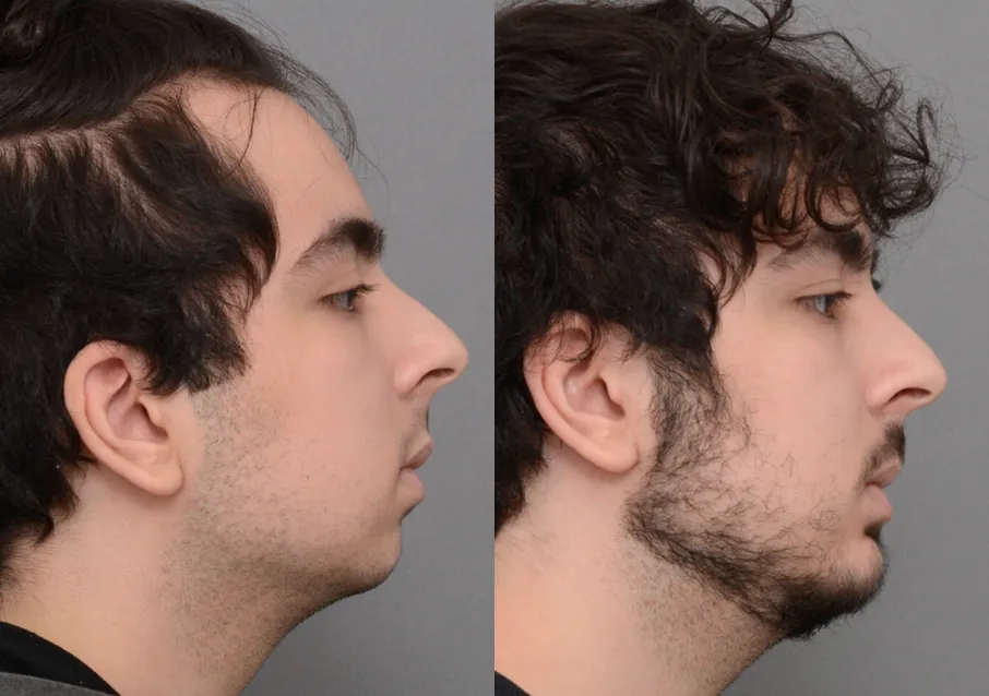 Chin Augmentation case #40376