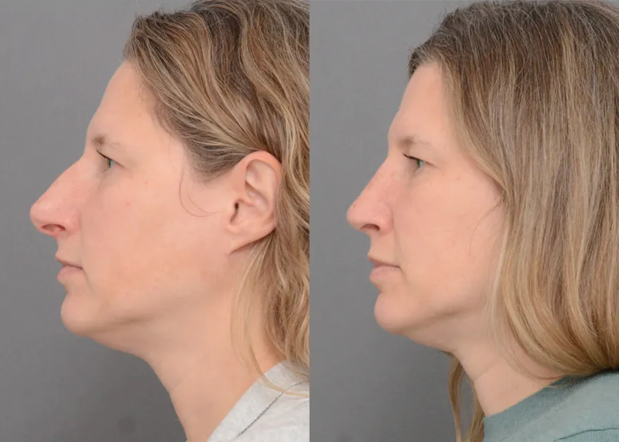 Primary Rhinoplasty case #40378