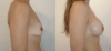 Breast Augmentation case #40687 slider thumbnail