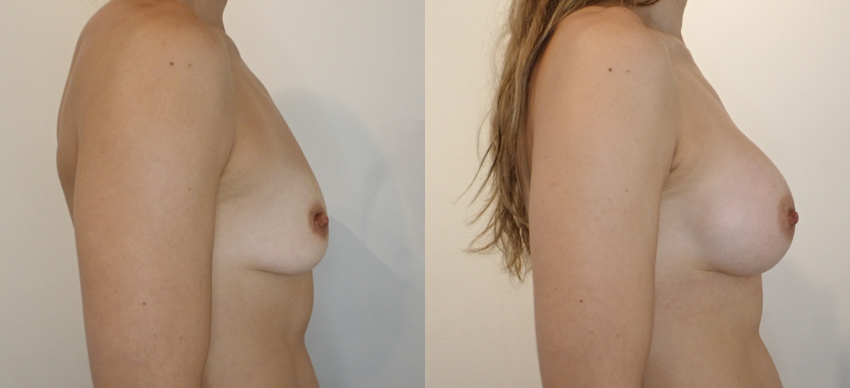 Breast Augmentation case #40687