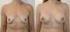 Breast Augmentation case #40687 slider thumbnail