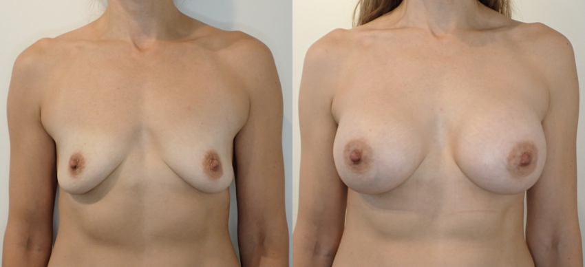 Breast Augmentation case #40687