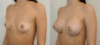 Breast Augmentation case #40690 slider thumbnail