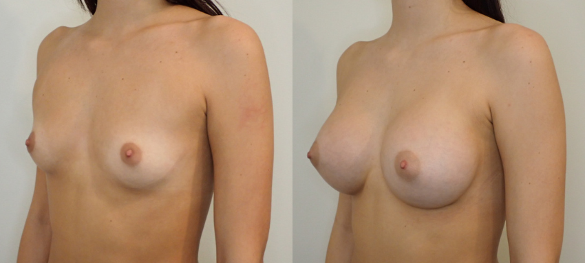 Breast Augmentation case #40690