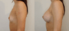 Breast Augmentation case #40690 slider thumbnail
