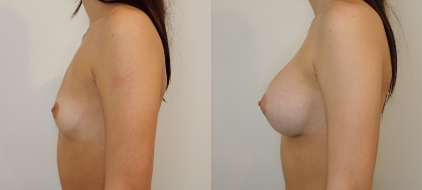 Breast Augmentation case #40690