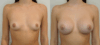 Breast Augmentation case #40690 slider thumbnail
