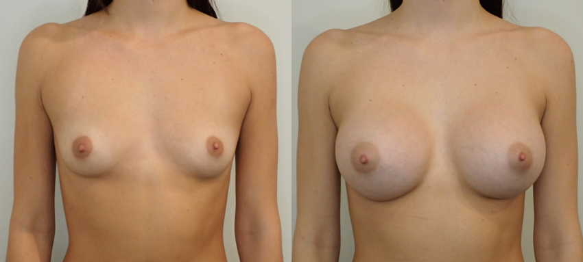 Breast Augmentation case #40690