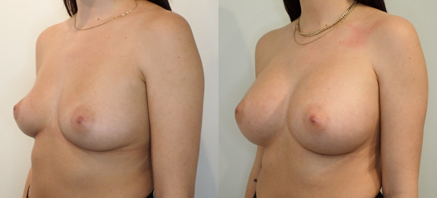 Breast Augmentation case #40695