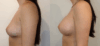 Breast Augmentation case #40695 slider thumbnail
