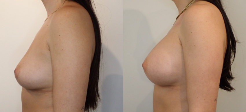 Breast Augmentation case #40695
