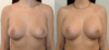 Breast Augmentation case #40695 slider thumbnail