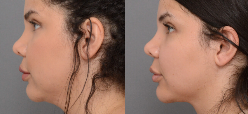Liposuction case #40673