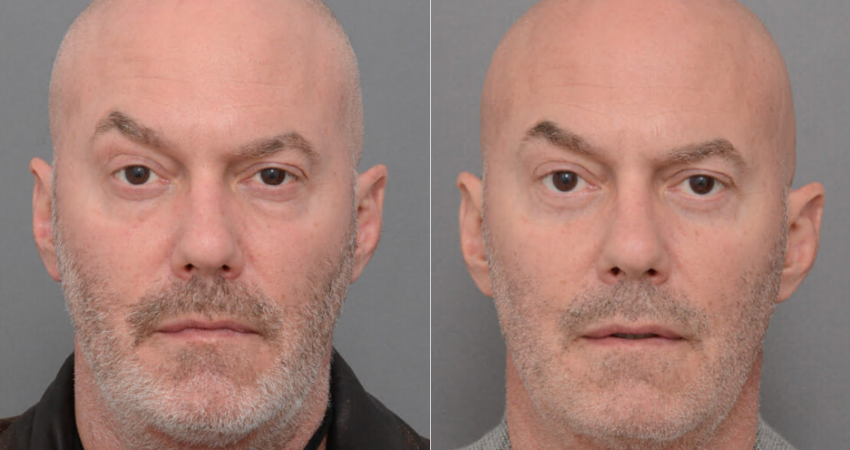 Blepharoplasty case #40685