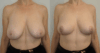 Breast Lift case #40675 slider thumbnail