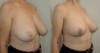 Breast Lift case #40675 slider thumbnail