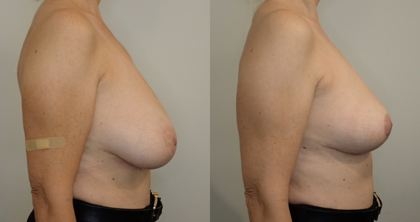 Breast Lift case #40675