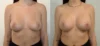 Breast Augmentation case #43013 slider thumbnail