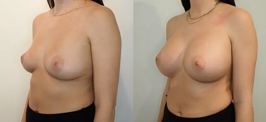 Breast Augmentation case #43013