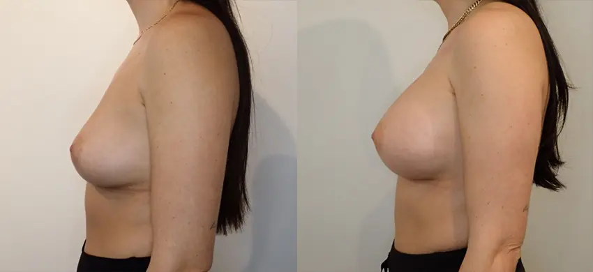 Breast Augmentation case #43013
