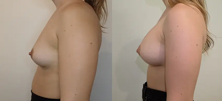Breast Augmentation case #43017