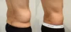 Liposuction case #43002 slider thumbnail