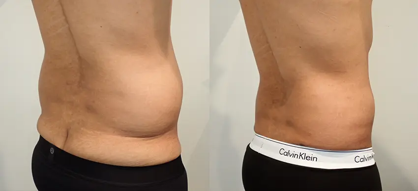 Liposuction case #43002