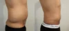 Liposuction case #43002 slider thumbnail