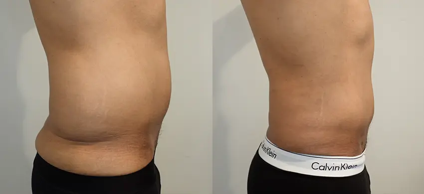 Liposuction case #43002