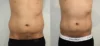 Liposuction case #43002 slider thumbnail