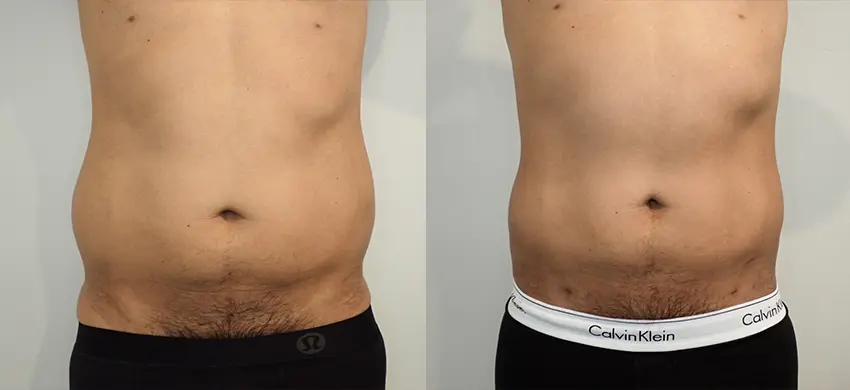 Liposuction case #43002