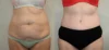 Tummy Tuck case #43006 slider thumbnail