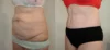 Tummy Tuck case #43006 slider thumbnail
