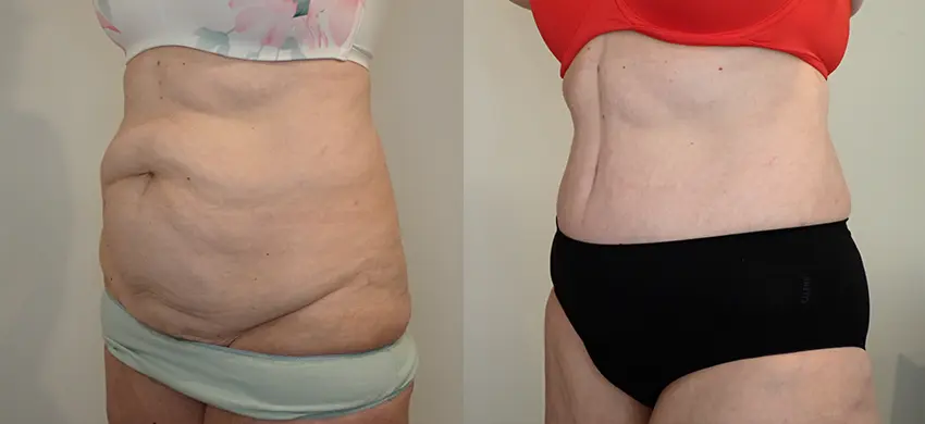 Tummy Tuck case #43006