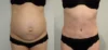 Tummy Tuck case #43009 slider thumbnail