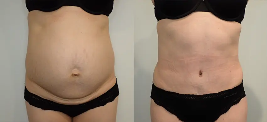 Tummy Tuck case #43009