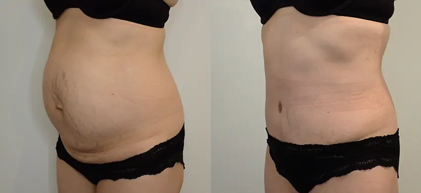 Tummy Tuck case #43009