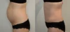 Tummy Tuck case #43009 slider thumbnail