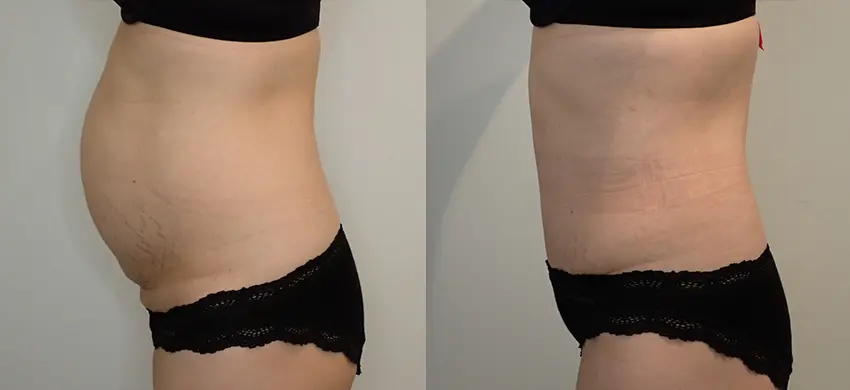 Tummy Tuck case #43009